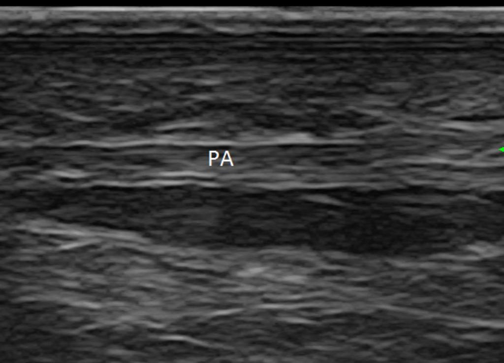 Fig. 3: Longitudinal scan of the palmar aponeurosis. PA: Palmar aponeurosis. The palmar aponeurosis covers muscles and tendons of the palm and consists of central, lateral and medial bundles.