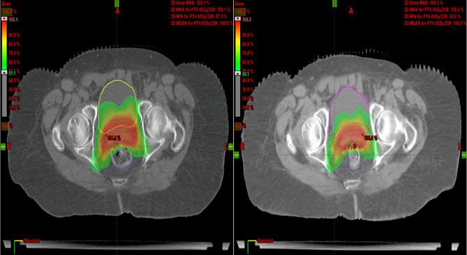 DOI:10.31557/APJCP.2019.20.1.229 Volume and Dose Assessment on Adapted CT Figure 4. Dose Distribution and DVH Spread on Planning CT and Adapted Planning CT of a Prostate Patient Table 5.
