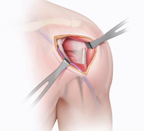 Surgical Approach The deltopectoral surgical approach for internal fixation of proximal humerus fractures uses the interval between the