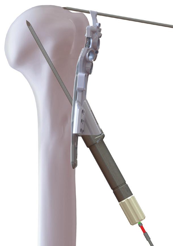 In the lateral view, the plate aligns with the shaft and runs along the lateral aspect of the bicipital groove. Adjust the final position based on the specific anatomy and fracture. 4.