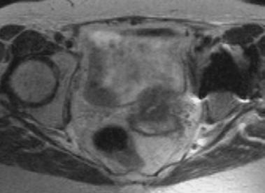 MRI anatomy: tumor regression