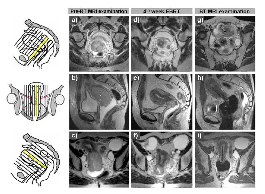 MRI for IGABT: Imaging recommendations