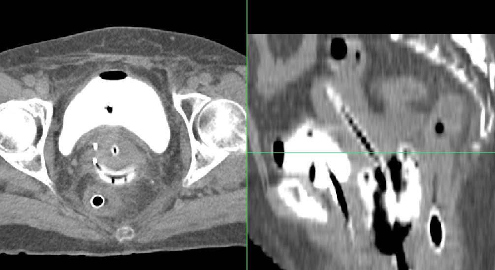 OAR contouring on CT Rectum and bladder CT and