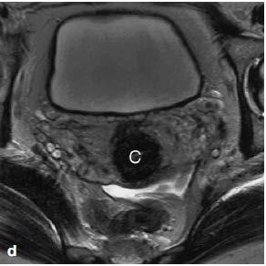 MRI anatomy: the normal uterus Cervical stroma: low SI =