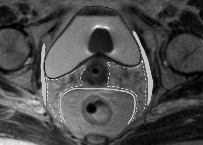MRI anatomy: the parametria Borders Anterior: urinary bladder