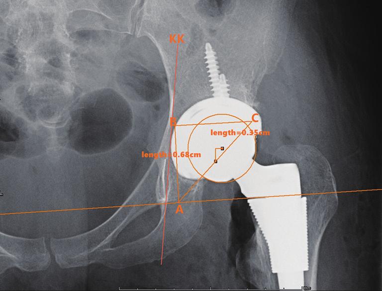 Annals of Joint, 2018 Page 3 of 6 Surgical procedure Figure 2 Determine the anatomic center of rotation in the anteroposterior view of the pelvis by Ranawat s triangle method: point A is located five