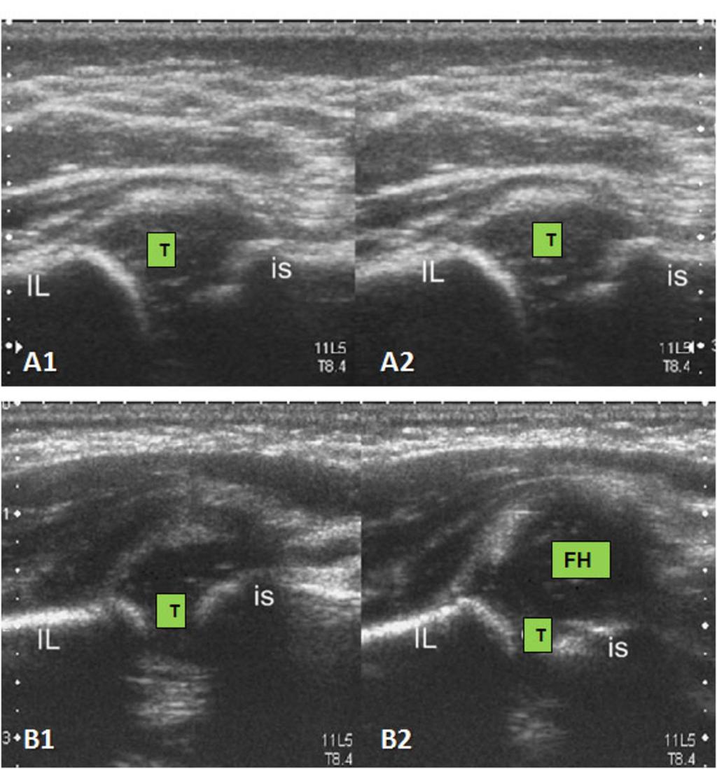 Fig. 9: A: Transverse flexion sonogram of a normal hip; B: Transverse flexion sonogram of an abnormal hip. Fig.