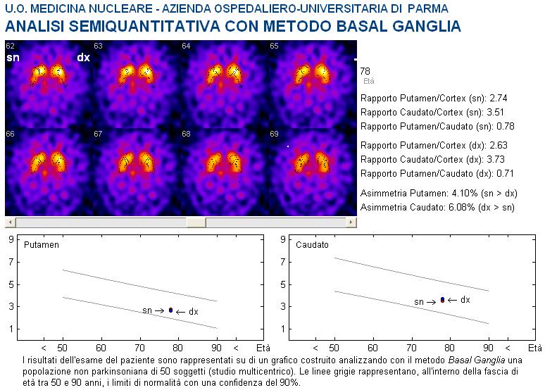 QUANTITATIVE ANALYSIS Method: Basal Ganglia dedicated Software Eur J Nucl Med Mol Imaging (2007) 3D method for striatal