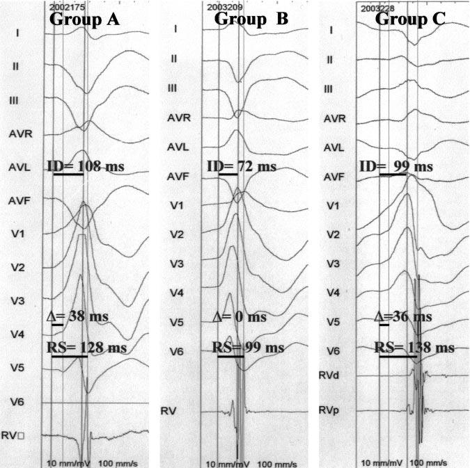 1846 Circulation April 20, 2004 Figure 4. Example of intervals measured in VTs from each group.