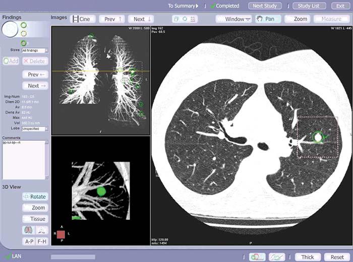 Screening CT for Pulmonary Fig. 1 Computer-aided detection workstation user interface. Transaxial section at middle lung zone level contains lesion highlighted by green circle (right image panel).