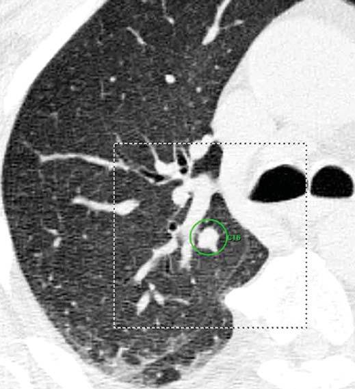 2 Transverse CT images with target field of view show solid nodules (green circles) only detected by computer-aided detection (CD) system.
