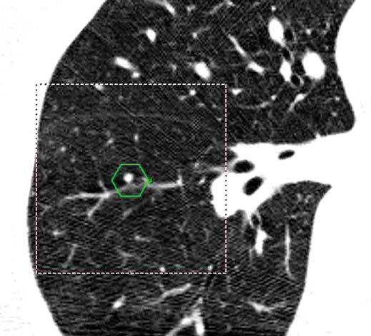 3 Small solid nodules (< 4 mm; CT peak > 100 H) were missed by computeraided detection because of size algorithm. Some were in contact with the pleura () or vessels (B).