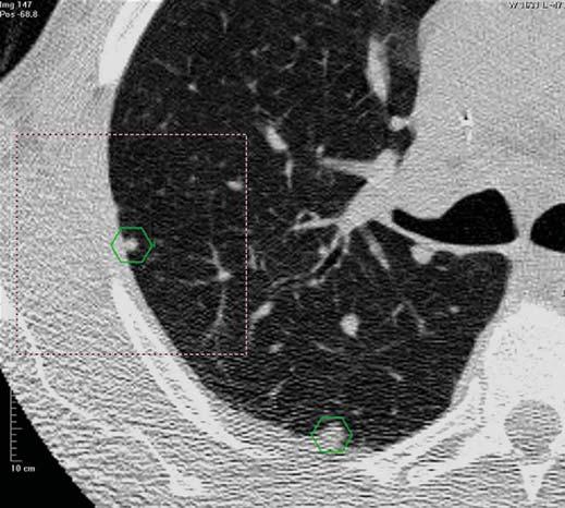 Yuan et al. sent a solid pulmonary nodule (Miller D et al., presented at the 2003 annual meeting of the Radiological Society of North merica).