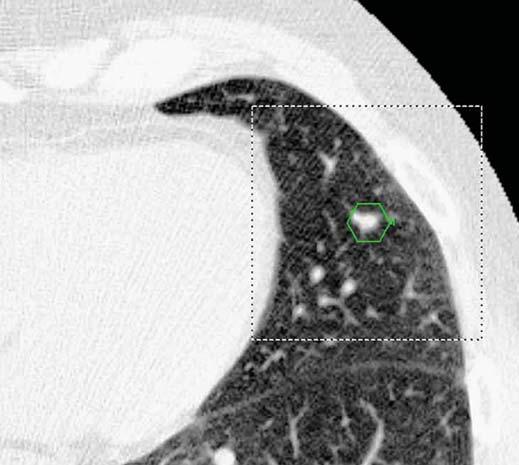 Screening CT for Pulmonary Fig.