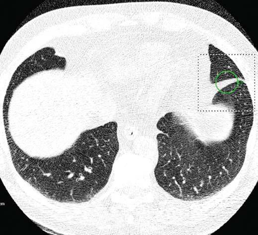 contacted pleura (in circle) and normal intrapulmonary structures and therefore were extracted by CD segmentation algorithm.