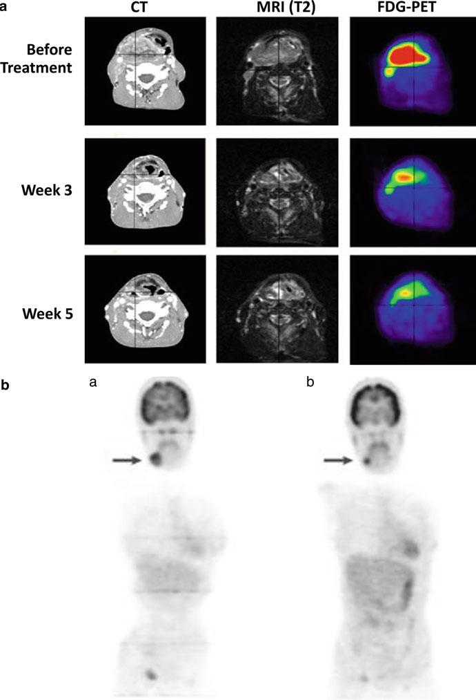 110 S. Naz et al. Fig. 5.2 ( a ) An example showing application of FDG-PET over conventional CT and MRI (T2-weighted sequence).