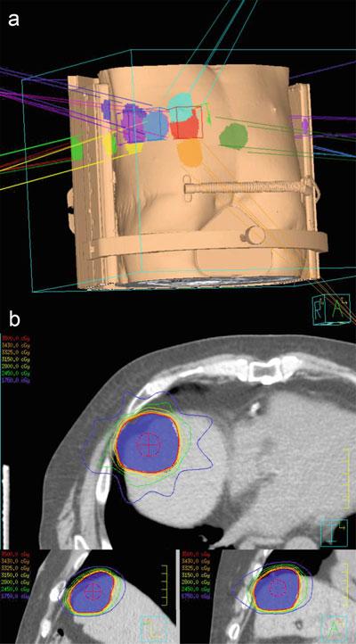 186 A.M. Laine et al. Fig. 8.2 Stereotactic body radiation therapy (SBRT) of a colorectal liver metastasis. (a ) Beam arrangements for treatment of liver dome lesion.