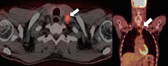 White arrows denote the primary tumor and nodal disease on CT and FDG-PET images; the solid lines delineate the radiotherapy targets, primary (red) and nodal (magenta) internal target volumes,