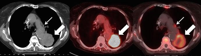 214 A. Gladwish and K. Han Fig. 9.7 Baseline CT (left ), FDG-PET (middle ), and FLT-PET (right ) images of a patient with newly diagnosed non-small cell lung cancer.