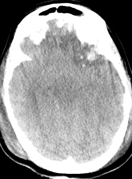 Severe TBI after
