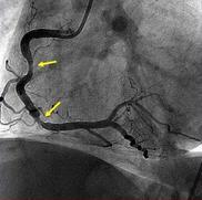 Fake contraindications wrong / outdated beliefs non-revascularized coronary lesions culprit only strategy pre-existing asymptomatic lesions patients on β blocker