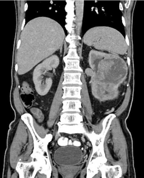 Renal cell carcinoma is the most common malignant tumour in old age where as wilms REFERENCES: 1. Kass DA, Hricak H, Davidson A J. Renal malignancies with normal excretory urograms.