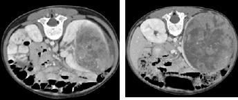 tumor extent Contrast enhanced CT: low density, intrarenal mass rim of compressed