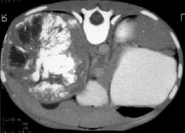 Extension 5-10% of cases Often clinically silent May extend into heart (30%) Tumor
