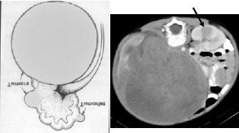 Focal Nephroblastomatosis Rhabdoid Tumor
