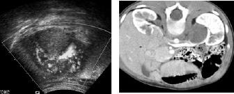 Kidney Rhabdoid Tumor 2.