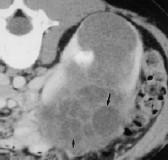 Clear Cell Sarcoma: Imaging Mesoblastic Nephroma: Imaging