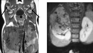 margins Bone metastases Solid mass Cystic changes rare Well
