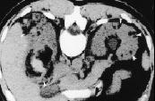 Sclerosis ARPKD Fatty Tumors: Angiomyolipoma Associated with