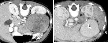 : MRI CT diagnosis: irregular extrarenal mass density