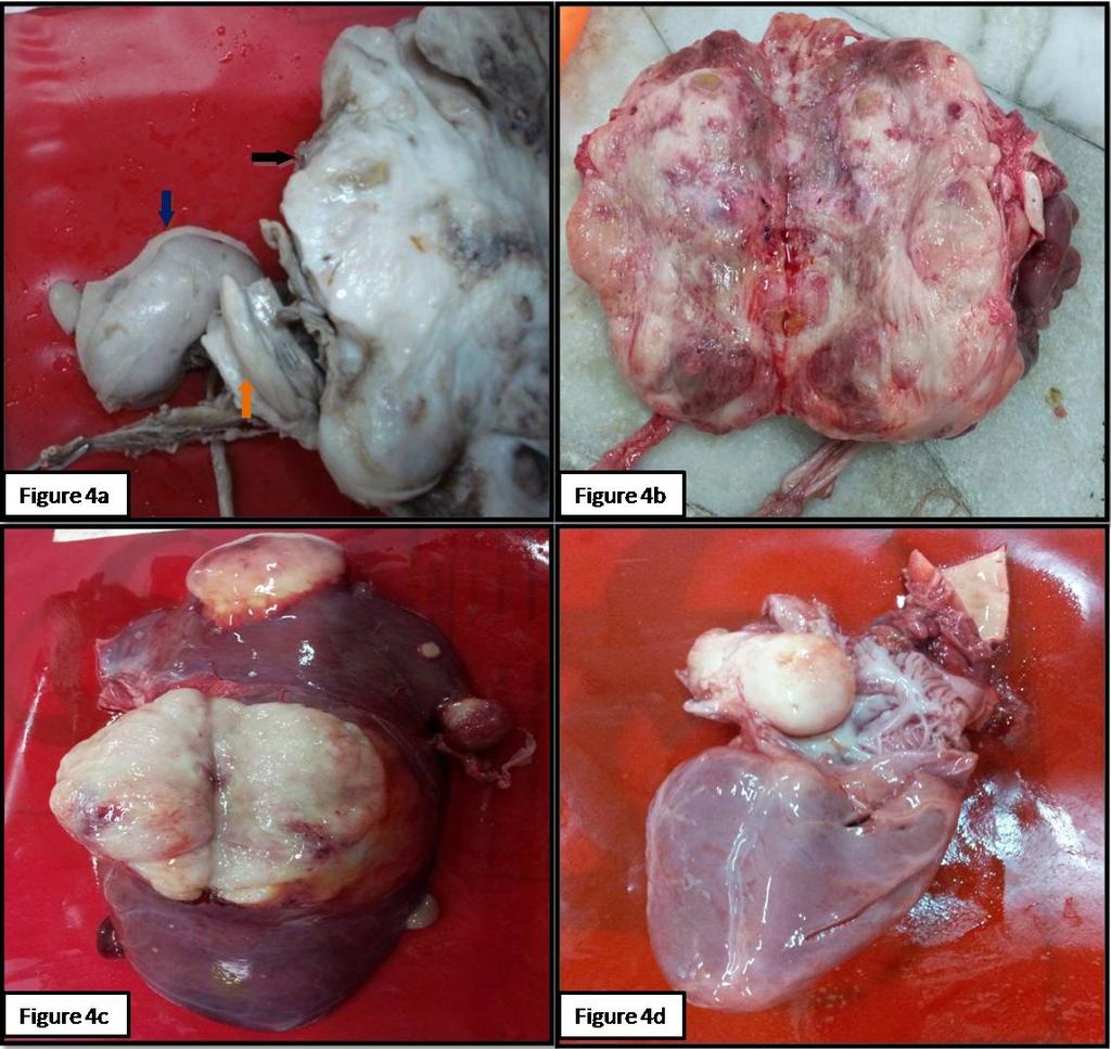 foamy macrophages and hemorrhage (H&E, x00). Fig. 4: 4a- Kidney urinary bladder (KUB) block of Wilms tumor in an autopsy case.