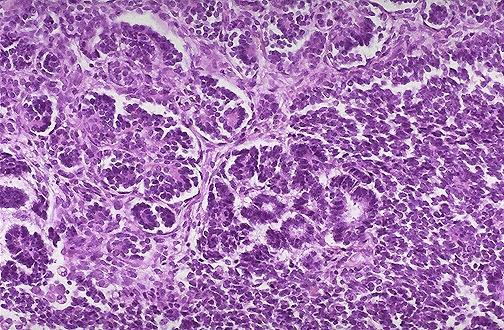 Wilms tumor Wilms tumor resembles the fetal nephrogenic zone of the kidney.