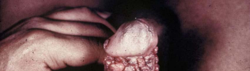 Malignant- squamous cell carcinoma
