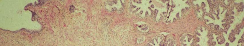 PIN Prostatic Intraepithelial