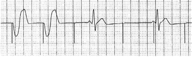 KNOWLEDGE CHECK Patient C Patient C Feedback Pacing spikes are occurring without depolarization of the cardiac tissue consistent with loss of capture.