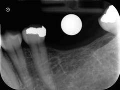 TREATMENT PLANNING We took a periapical X-ray with a ball bearing, as well as a CBCT scan with the CS 8100 3D.