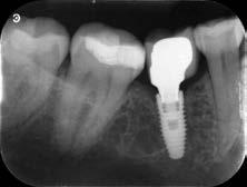 occlusal load on the implant. FOLLOW UP During the follow-up appointment one week after surgery, the patient reported no pain and there were there no problems with the implant site.