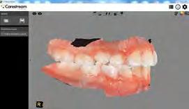 Foucart s staff typically scans 7-8 patients per day and can complete both arches in about 5 minutes although they ve completed the process, including a palatal scan, in as little as 3 minutes, 13