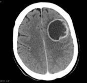 Cerebral Abscess Usually spread from con*guous areas, mastoids, sinuses and ears Hematogenous spread