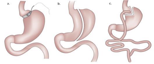 Bariatric & metabolic surgery: metabolic added to the name this century All are performed laparoscopically Adjustable gastric band Sleeve Gastrectomy Roux-en Y gastric bypass 10% 70% 20% Pulmonary