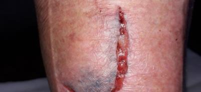 Flap lacerations Key points: Control bleeding