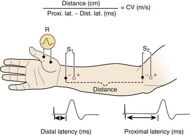 Purpose of EMG Confirms polyneuropathy Helps characterize PN Character