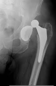 Hip Replacement Benefits of