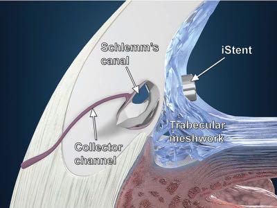 ExPRESS Mini-Shunt MIGS Microinvasive Glaucoma Surgery Success IOP <21 mmhg with or