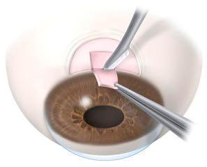 Trabeculectomy Trabeculectomy Conjunctival flap