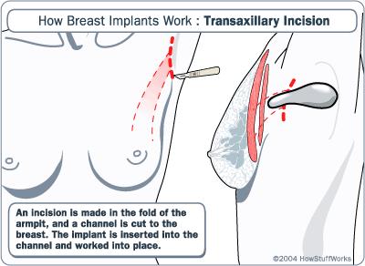 Transaxillary Breast Augmentation Involves a small incision made within the armpit, through which cosmetic surgeon will place the breast implant using a specialized camera and instruments to ensure